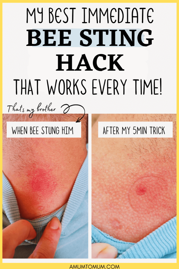 Natural Bee Sting Remedy - Works Like Magic!